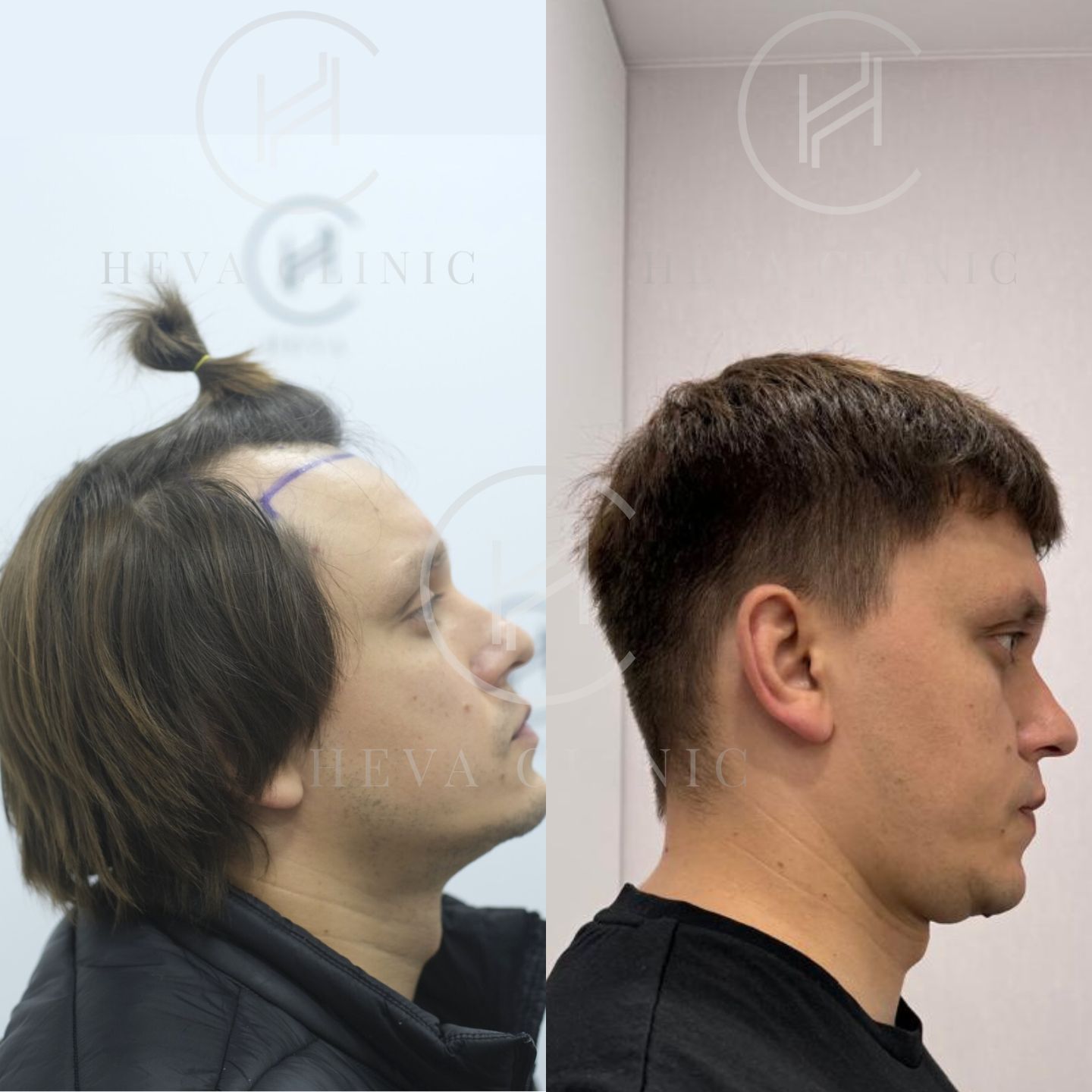 Before and after hair transplant widows peak difference