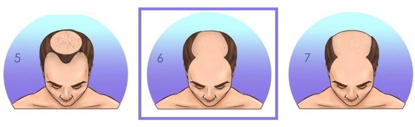 Norwood-stage-6-hair-transplant-candidate