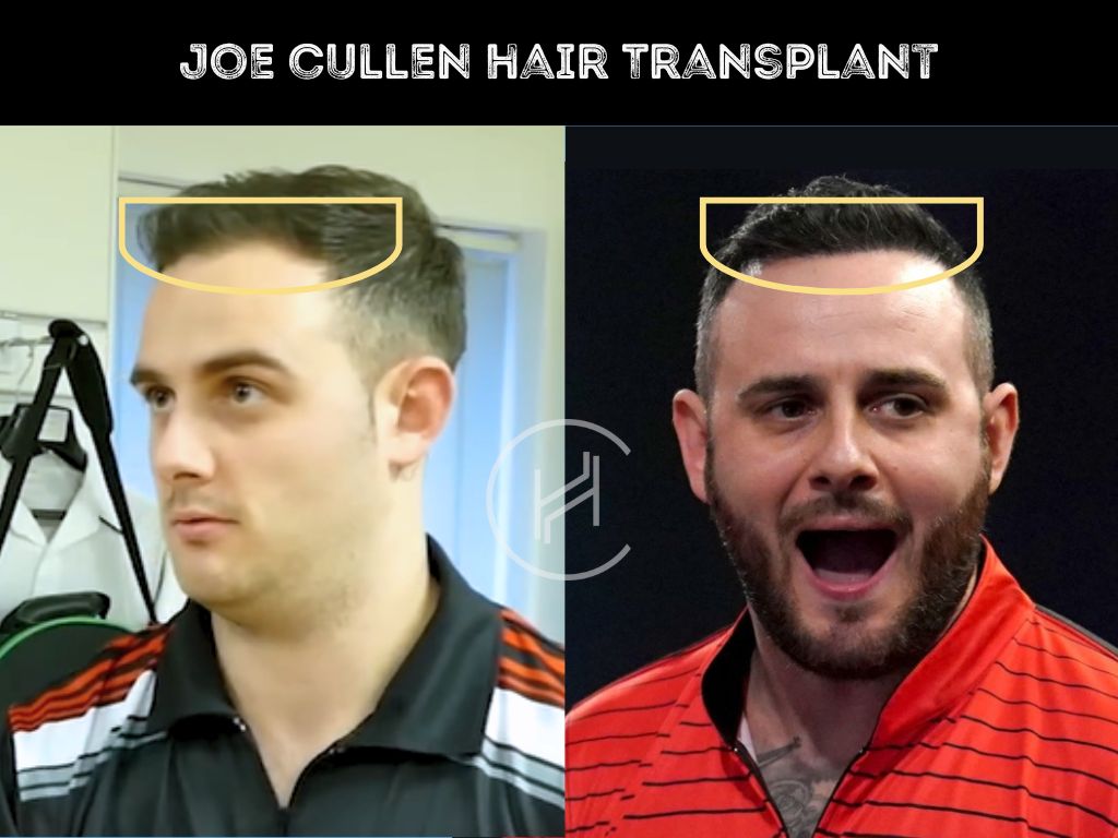 joe cullen hair Transplant result before and after