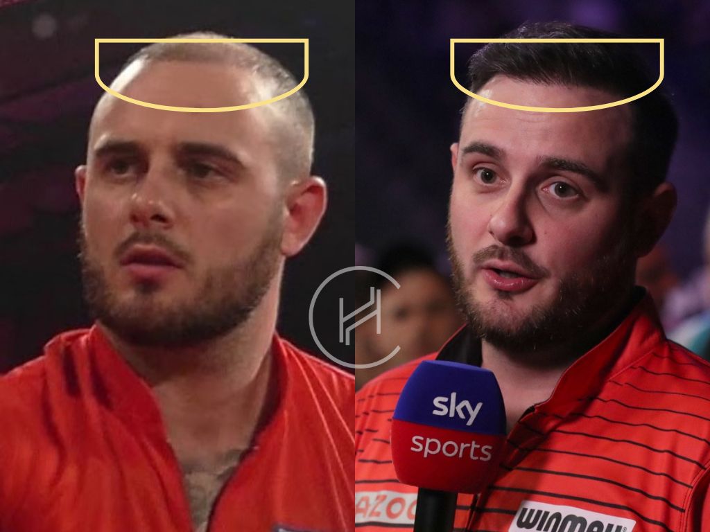 joe cullen hair transplant before and after result