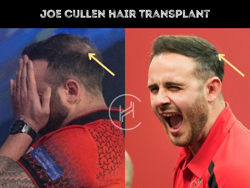 joe-cullen-hair-transplant-before-and-after