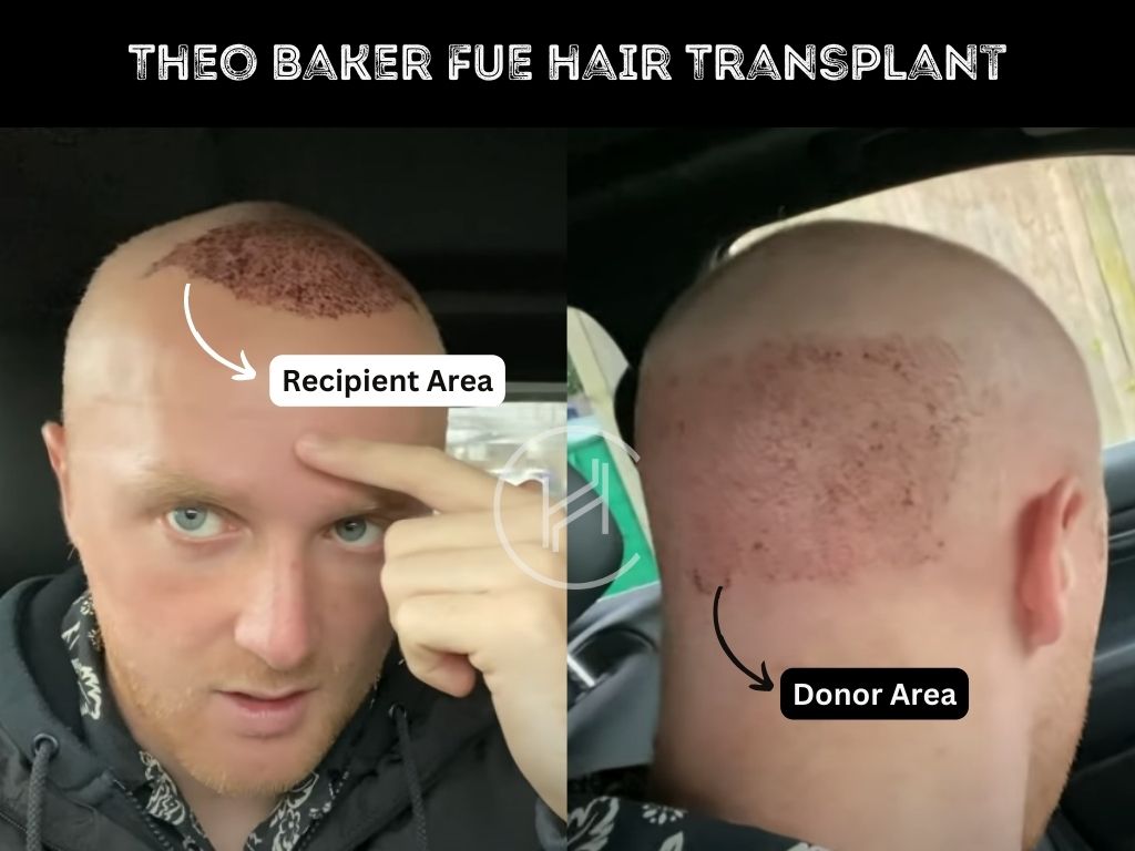 theo-baker-fue-hair-transplant