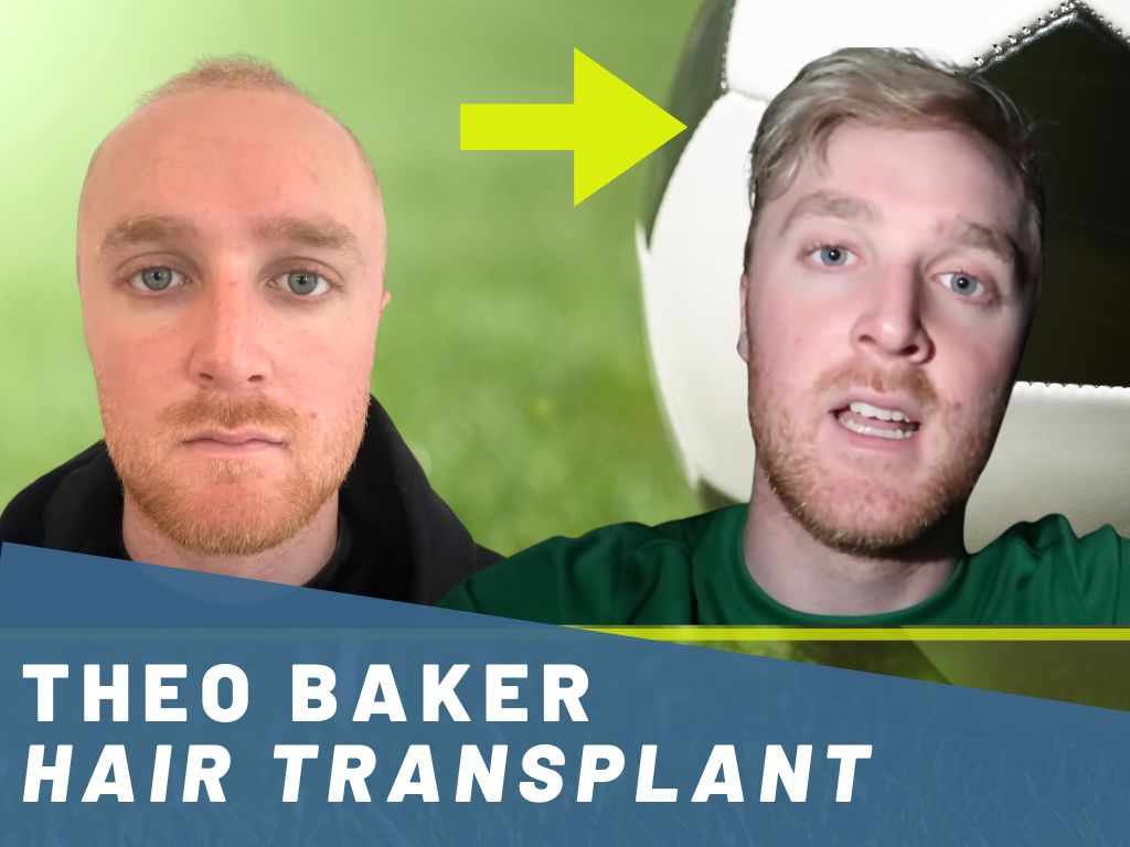 theo-baker-hair-transplant-analysis-banner