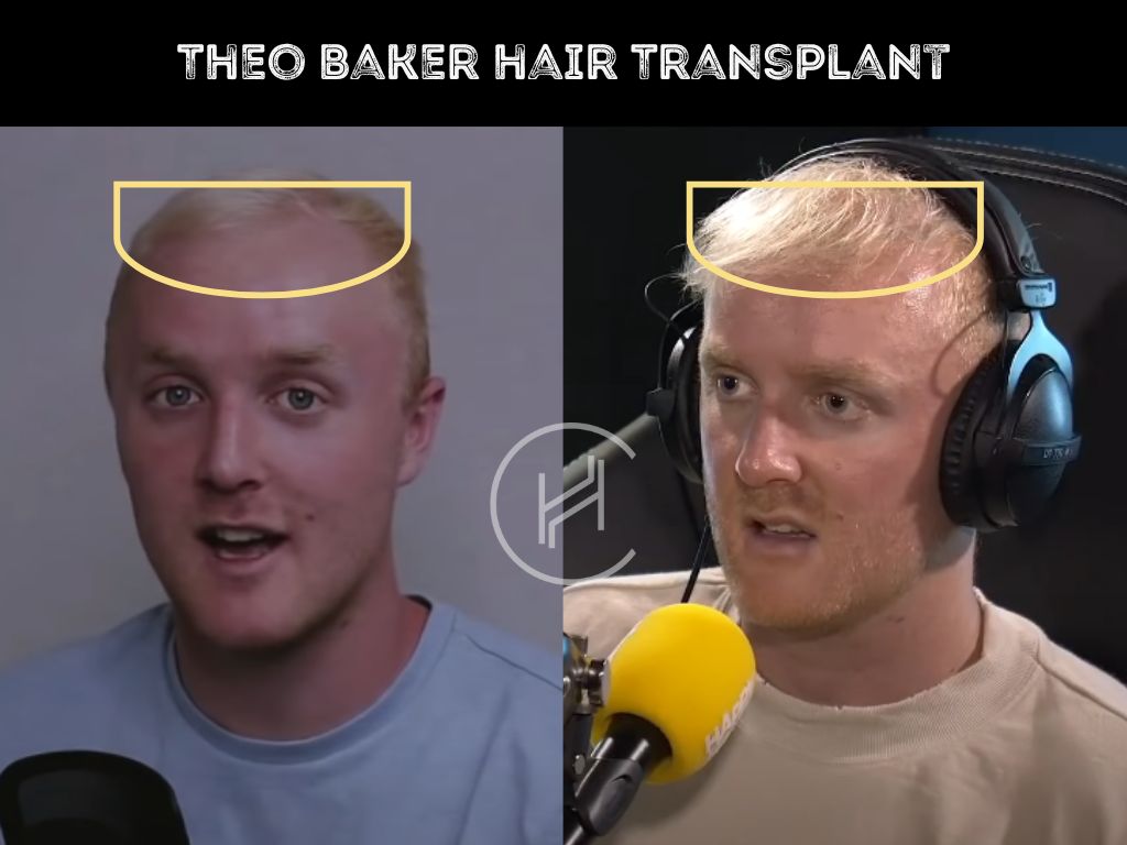 theo baker - hair transplant before after result