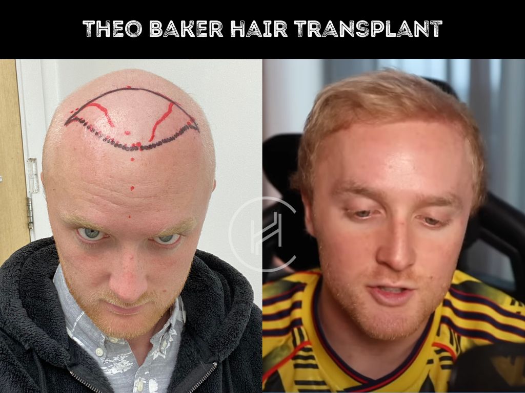 theo baker hair transplant before after