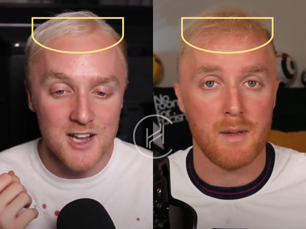 theo baker hair transplant before and after result