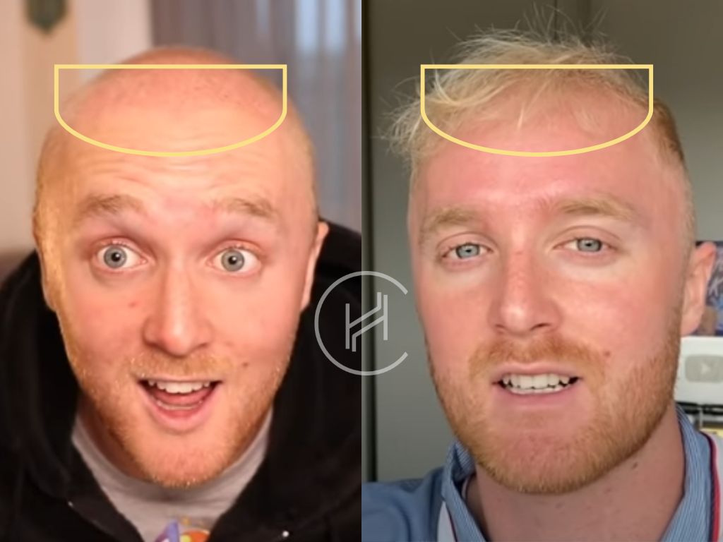 theo-baker-hair-transplant-before-and-after