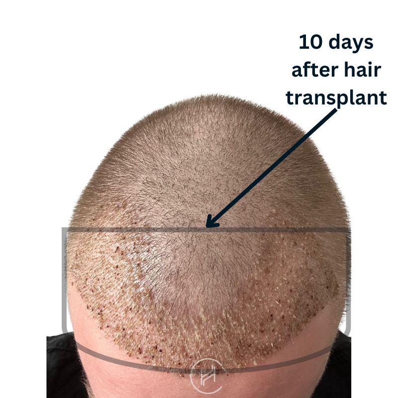 10 days after hair transplant before shock loss