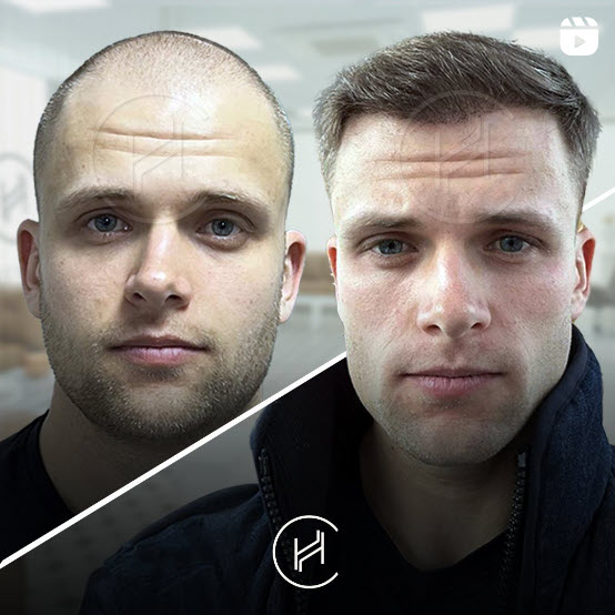 4700 grafts hair transplant before and after at HEVA
