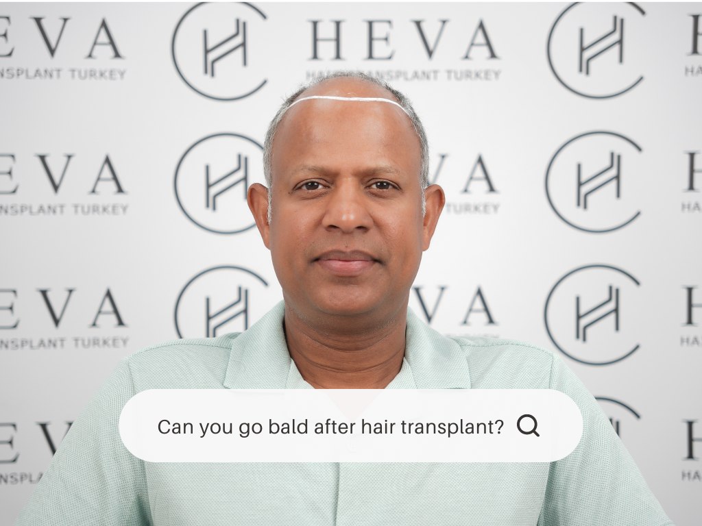 Can you go bald after hair transplant