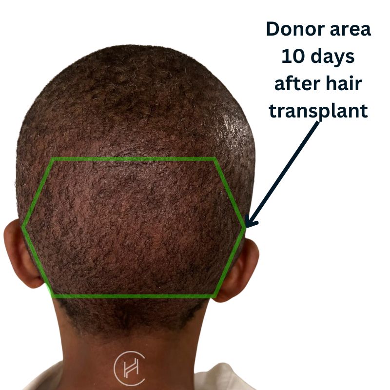 Donor area 10 days after hair transplant
