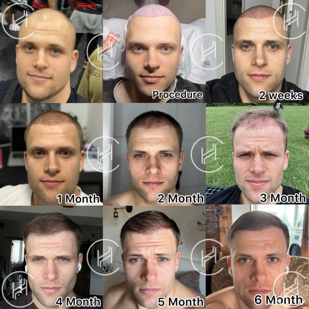 Hair transplant growth timeline pictures monthly