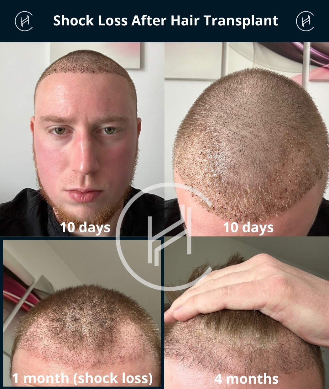 Shock loss after hair transplant timeline