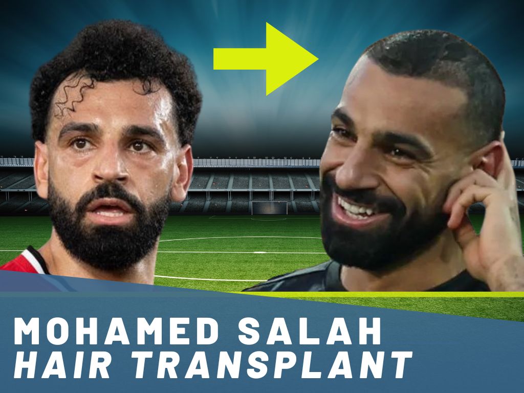 mohamed salah hair transplant analysis banner