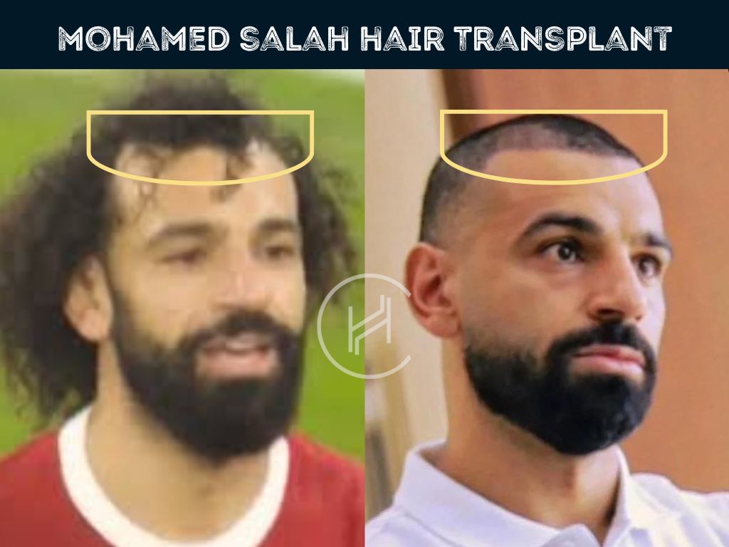 mohamed salah hair transplant before after result