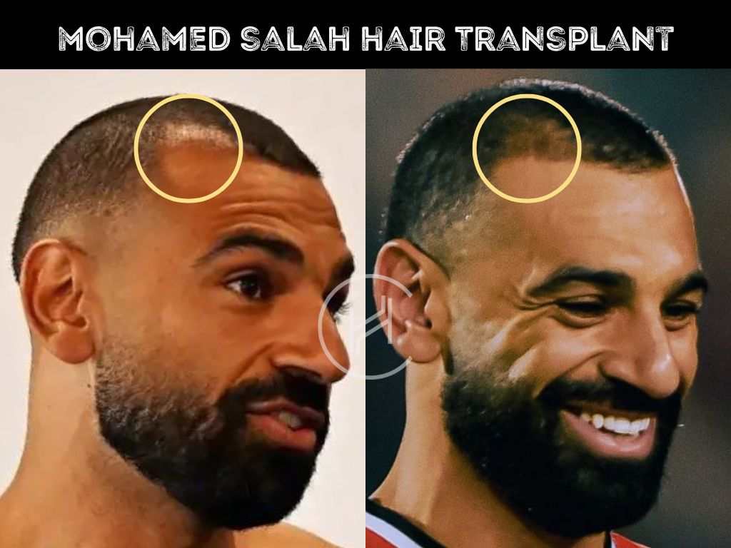 mo salah hair transplant before after