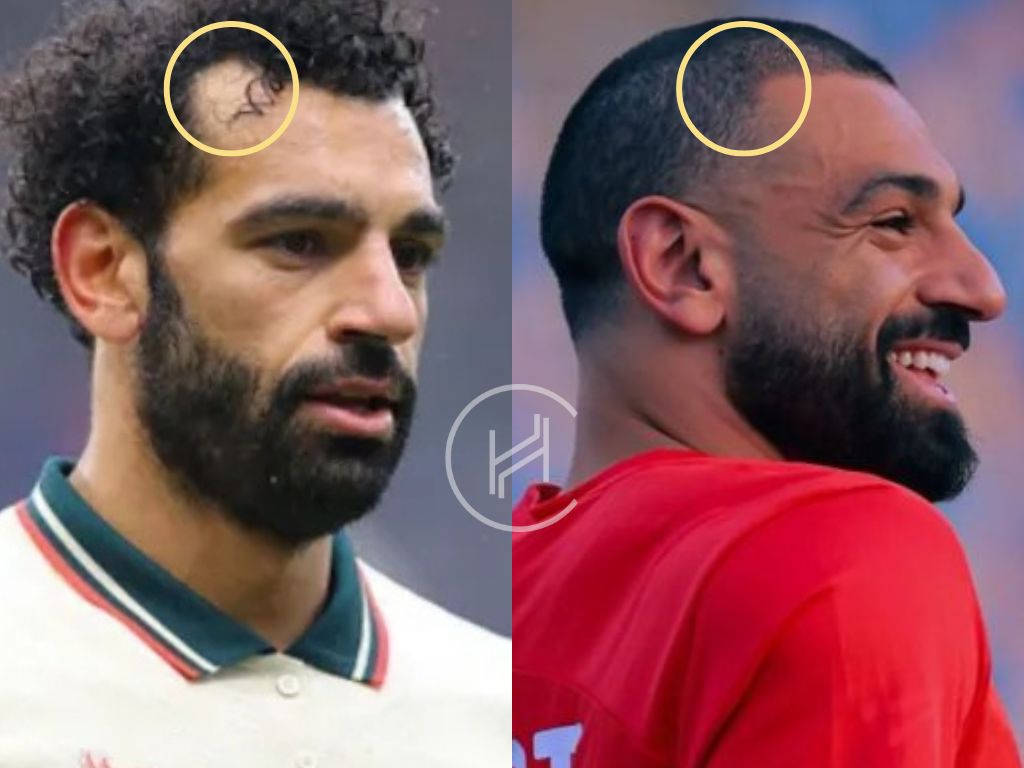 mohamed salah hair transplant before and after result