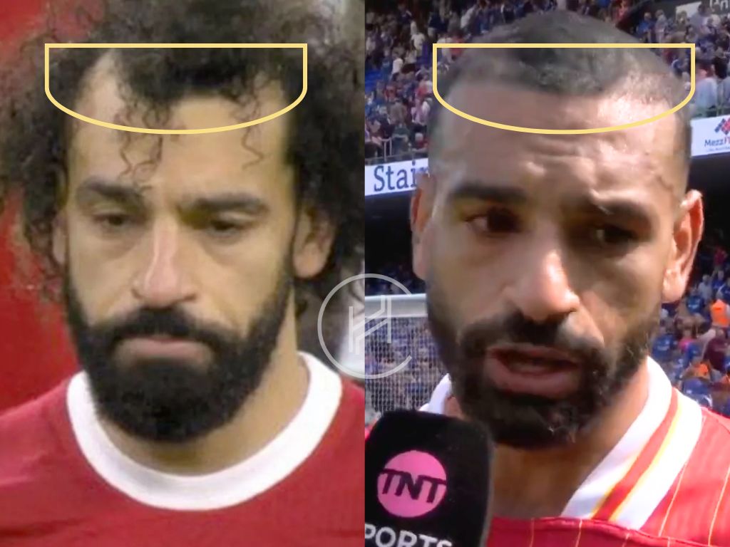 mohamed salah hair transplant before and after