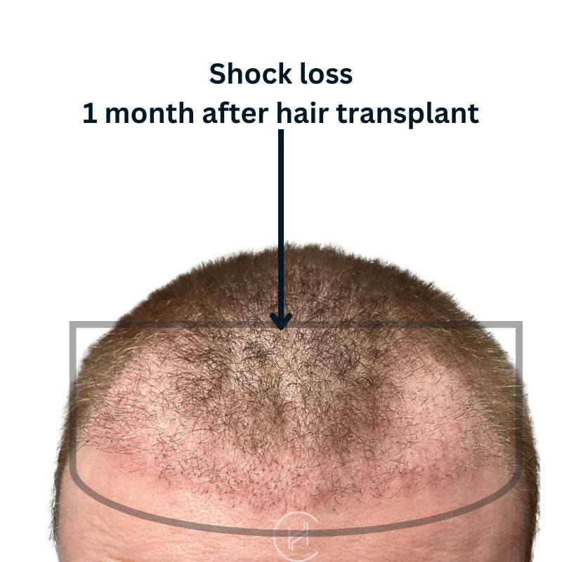 shock loss - 1 month after hair transplant