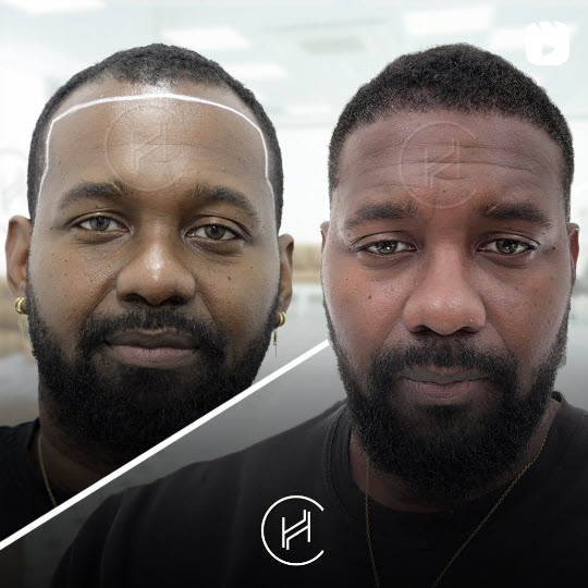 afro hair transplant before & after result - heva clinic istanbul