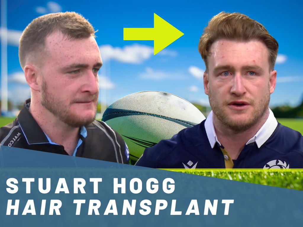 stuart hogg hair transplant analysis banner