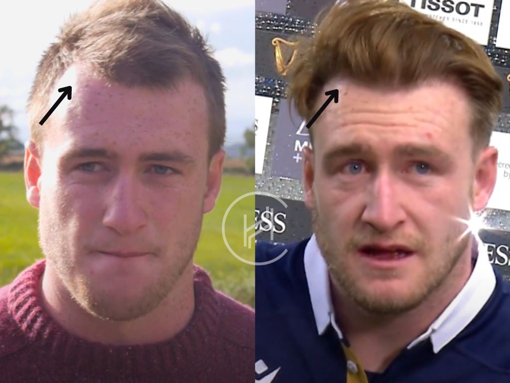 stuart hogg hair transplant before and after