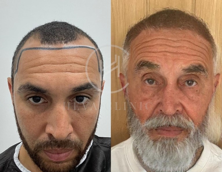 20 years after hair transplant result 20 years after hair transplant result