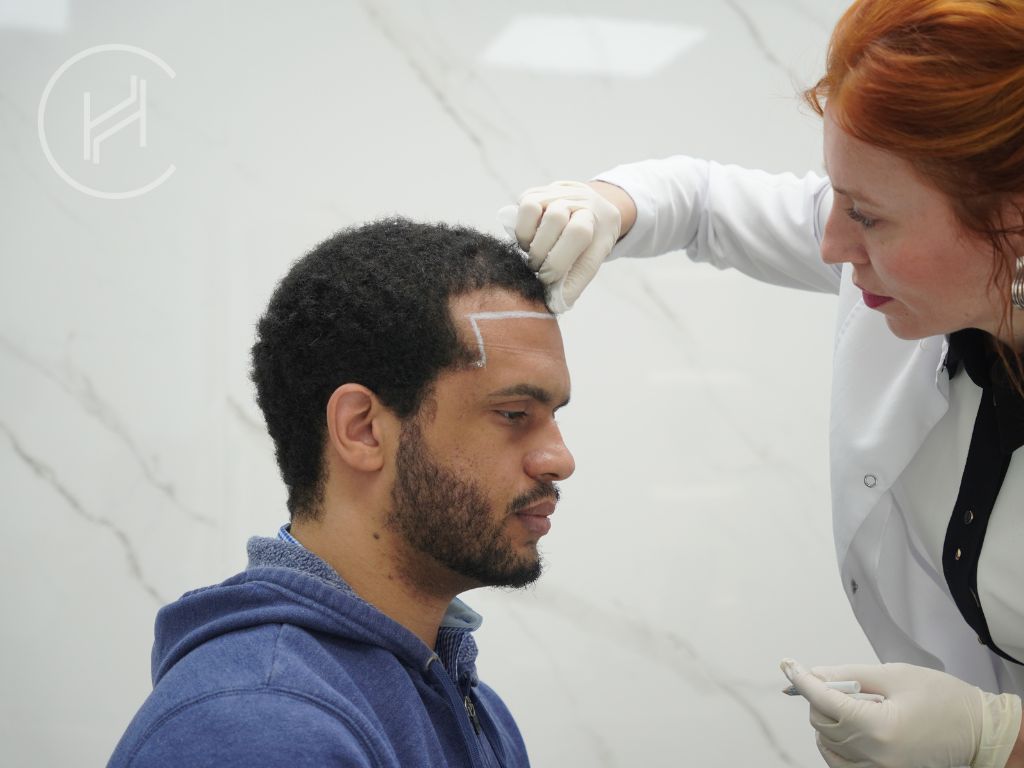 before long term hair transplant result before long term hair transplant result