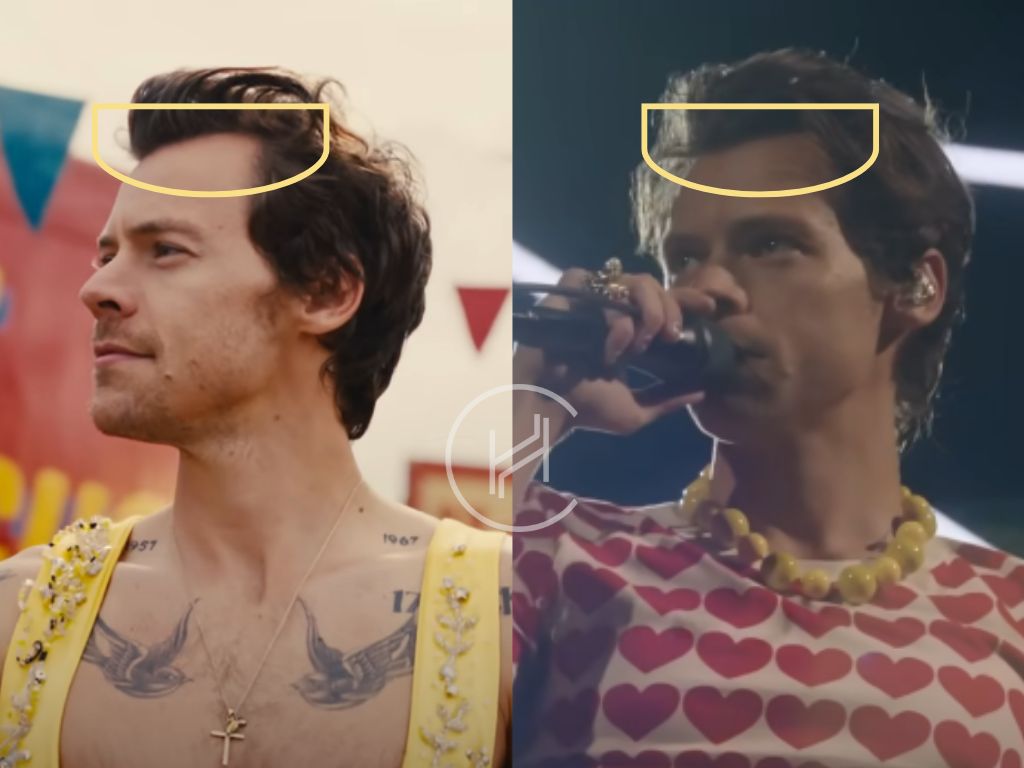 harry styles hair transplant before after result