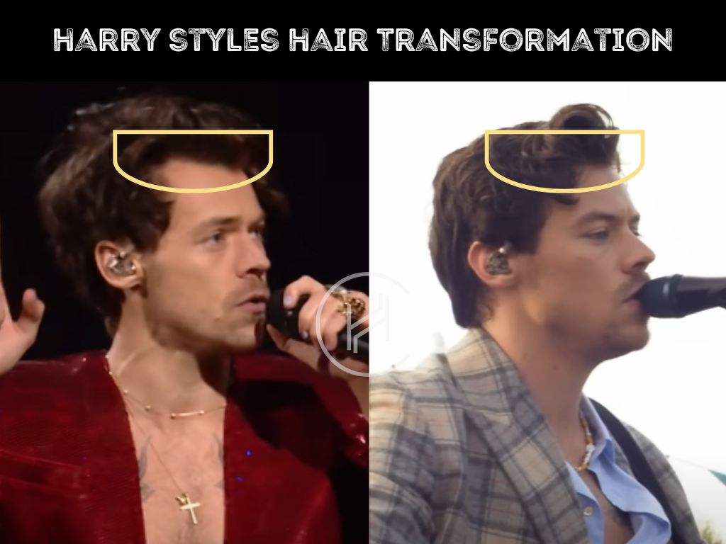 harry styles hair transplant before and after result transformation