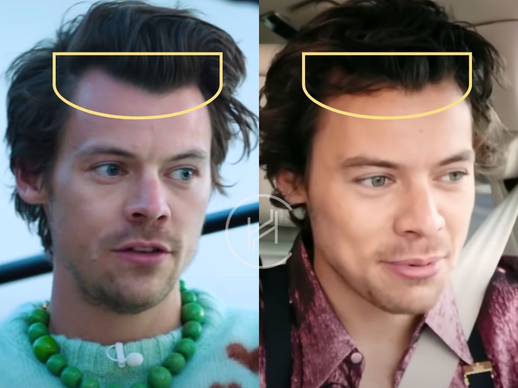 harry styles hair transplant before and after