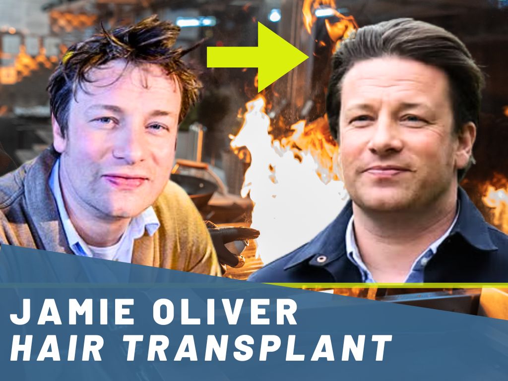 jamie oliver hair transplant analysis banner