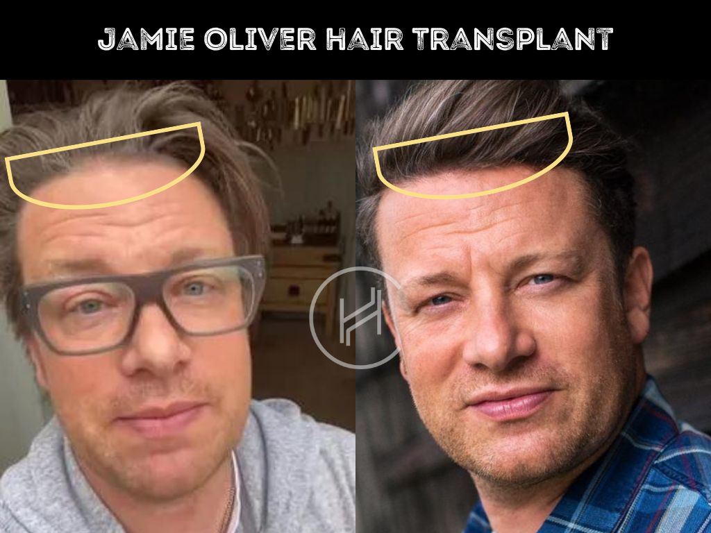 jamie oliver hair transplant before after result