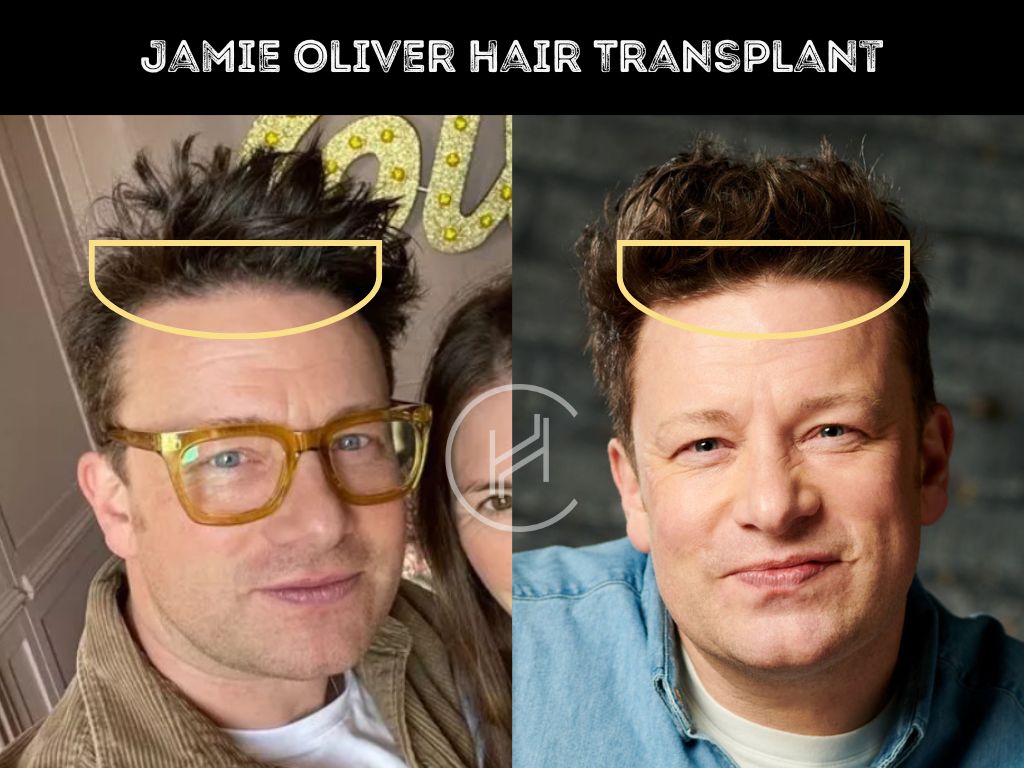 jamie oliver hair transplant before after