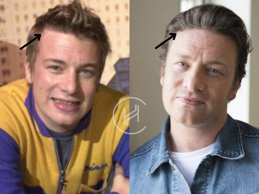 jamie oliver hair transplant before and after result