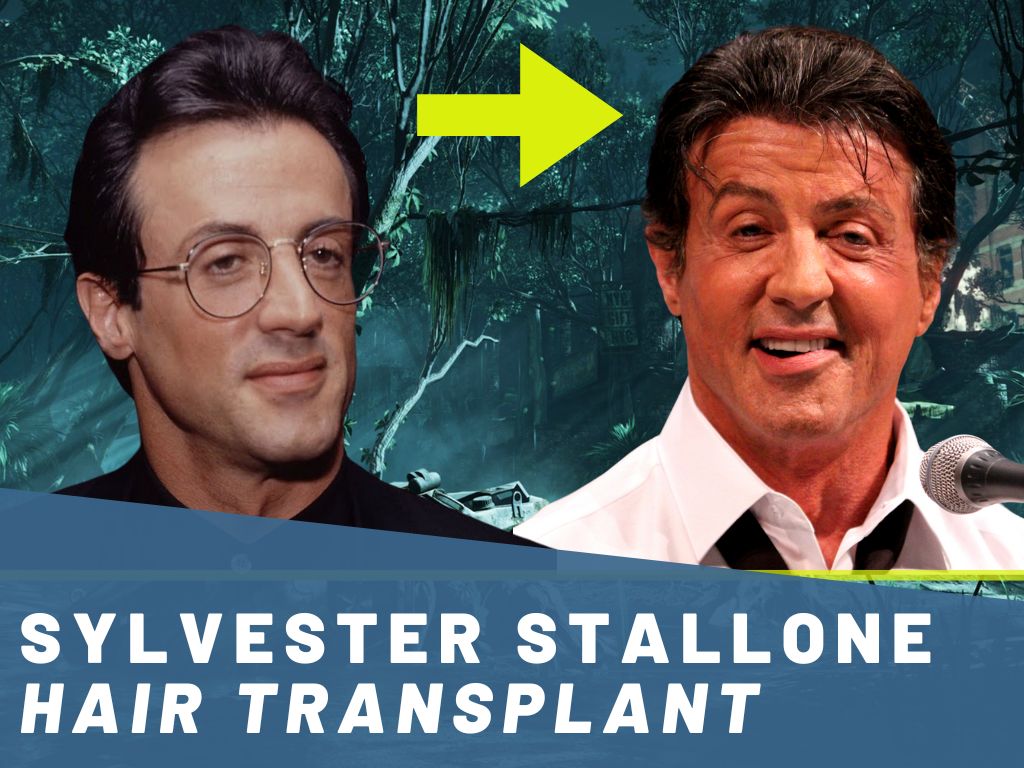sylvester stallone hair transplant analysis banner