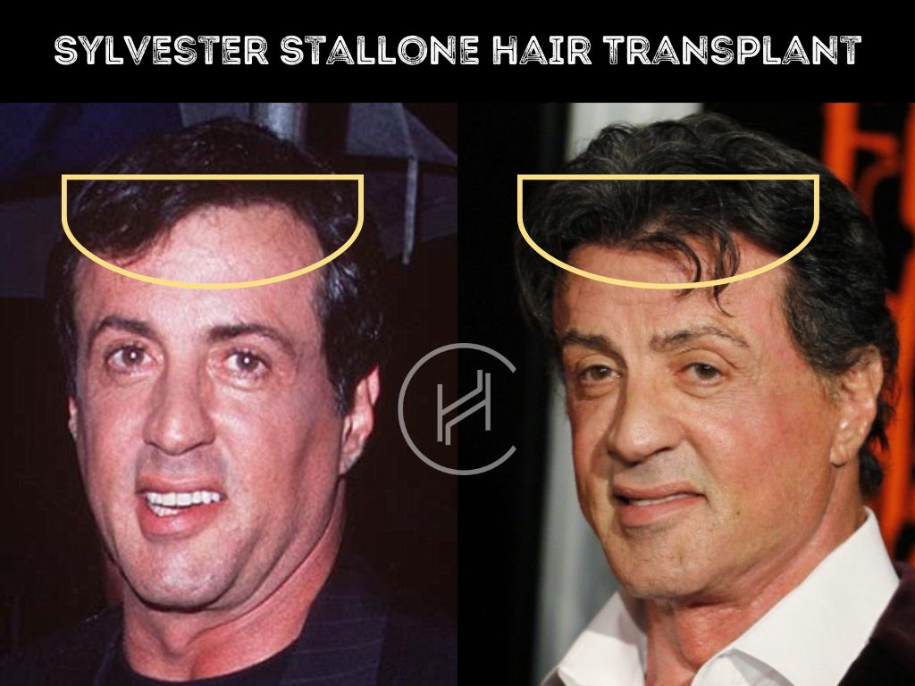 sylvester stallone hair transplant before after result