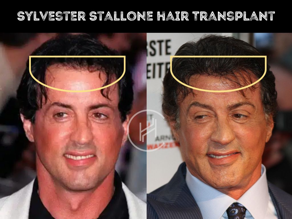 sylvester stallone - hair transplant before & after