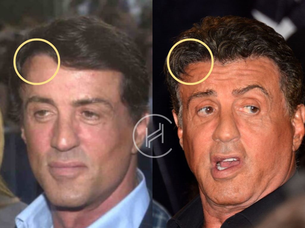 sylvester stallone hair transplant before and after result