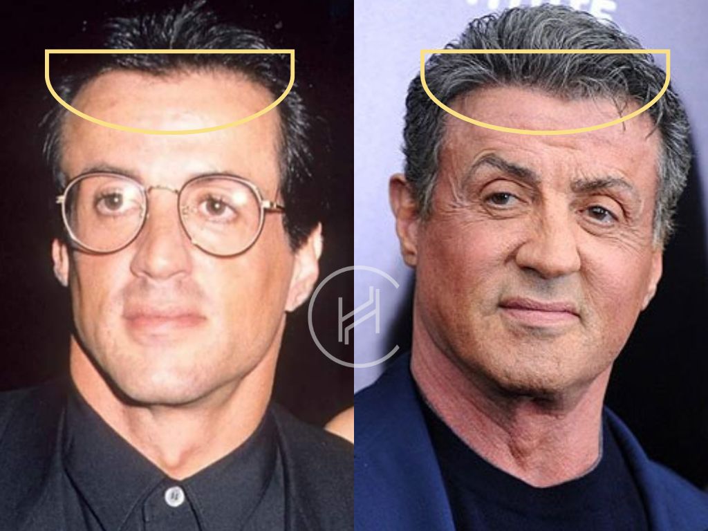 sylvester stallone hair transplant before and after