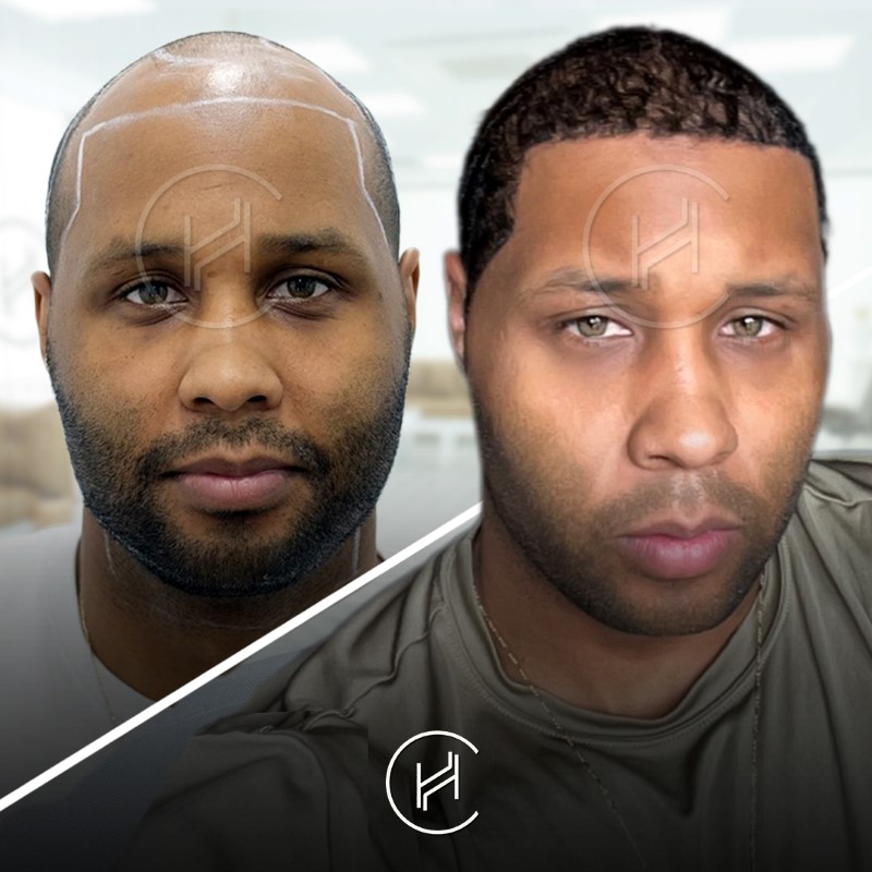 3700 grafts afro hair transplant before and after