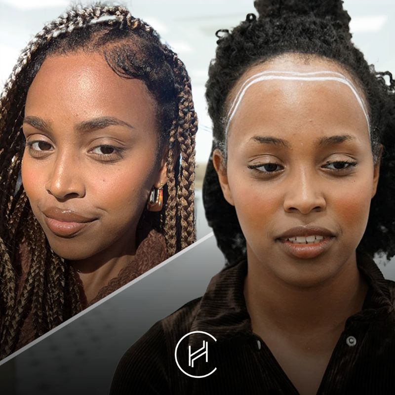 afro female hair transplant before and after results at heva clinic turkey