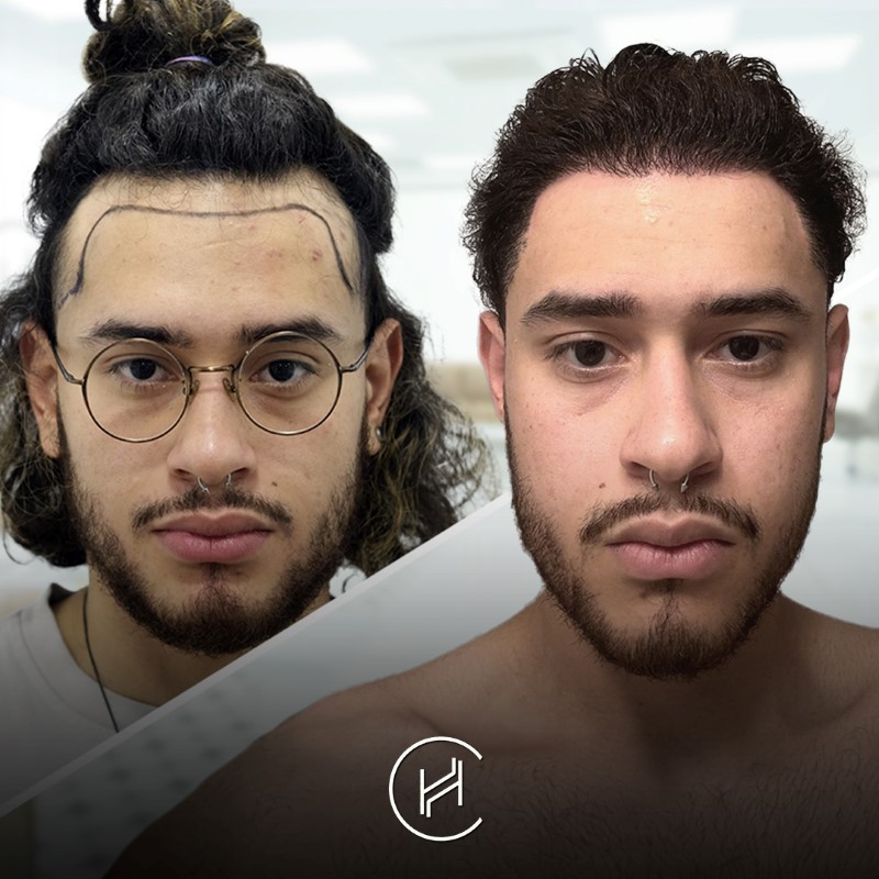 no shave hair transplant before and after result at heva clinic turkey