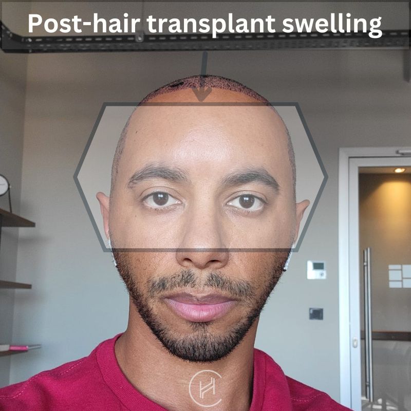 post-hair transplant swelling photo