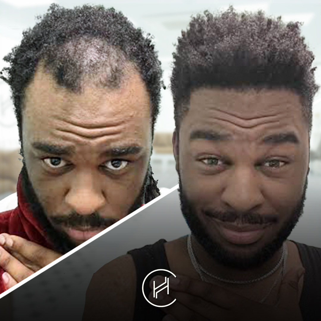 3600 grafts afro hair transplant before and after resultat heva