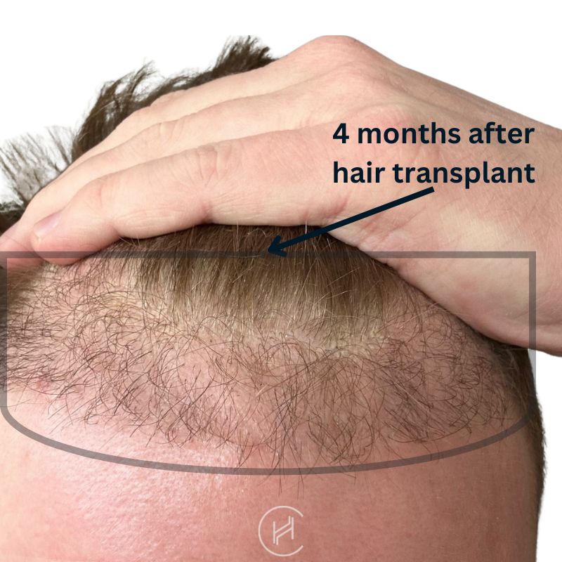 four months after hair transplant - shock loss disappears