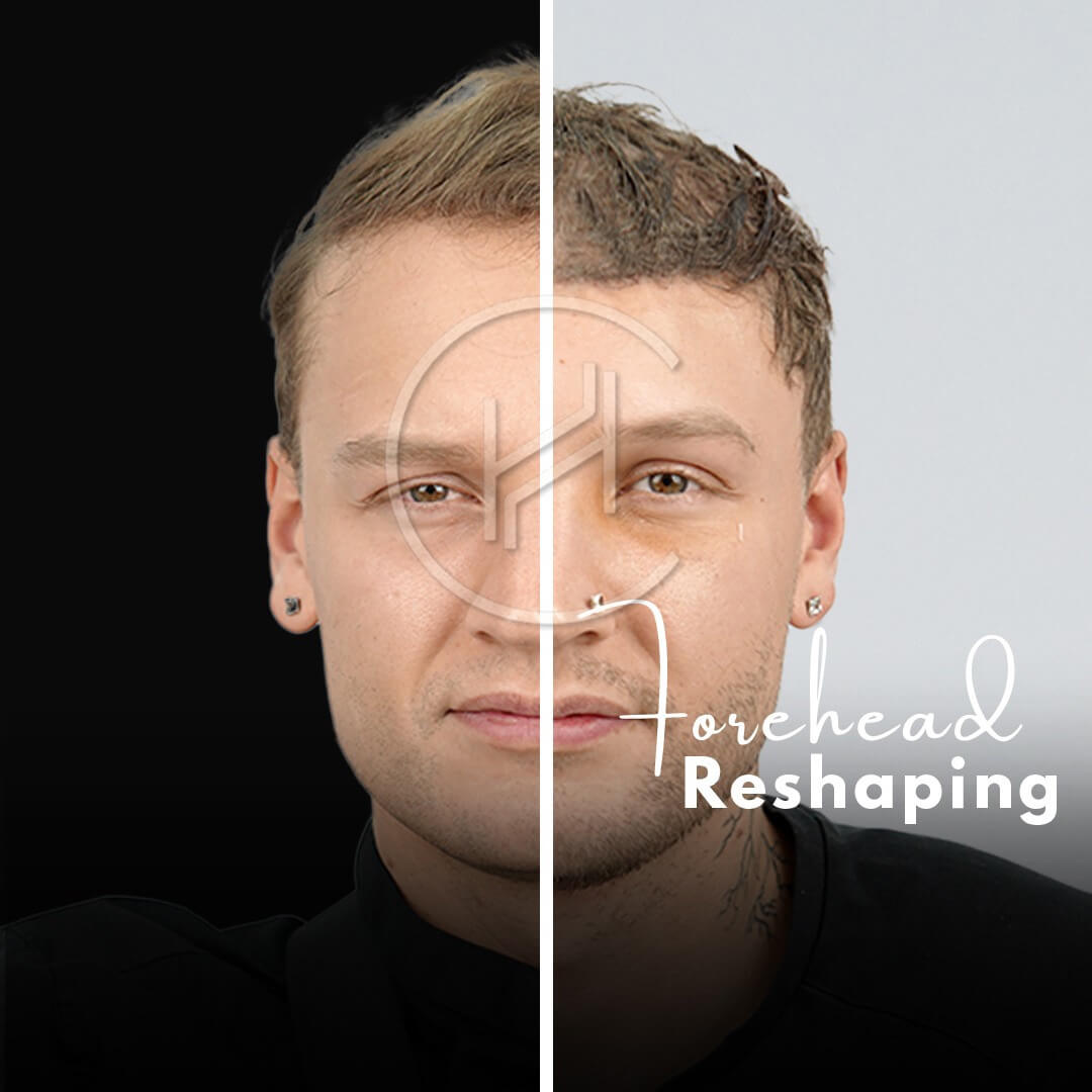 Blonde Man Forehead Reduction Hairline Lowering Before and After Result