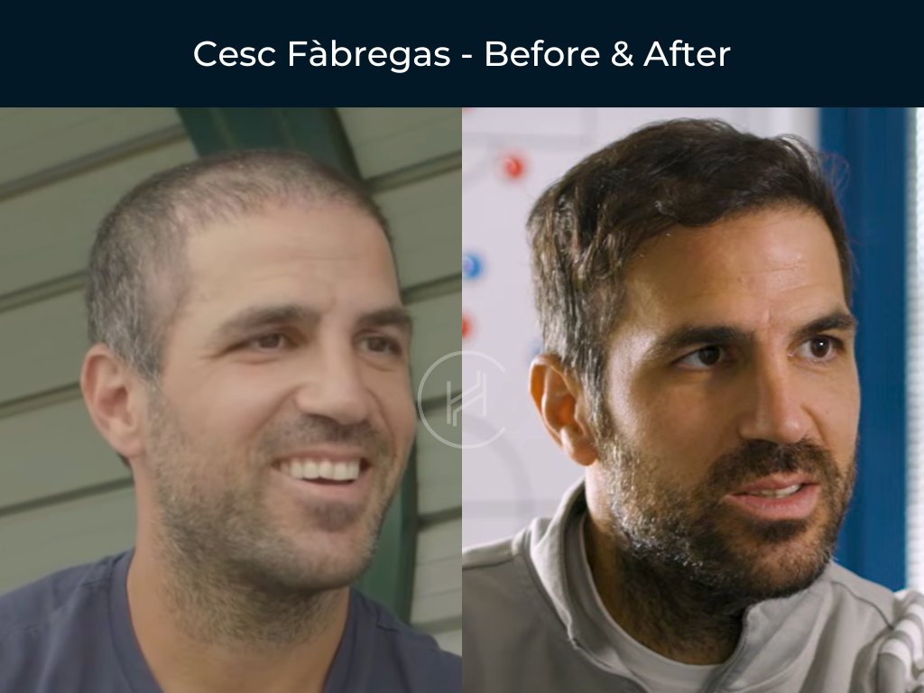 Cesc Fabregas - Hair Transplant Before and After Cesc Fabregas - Hair Transplant Before and After