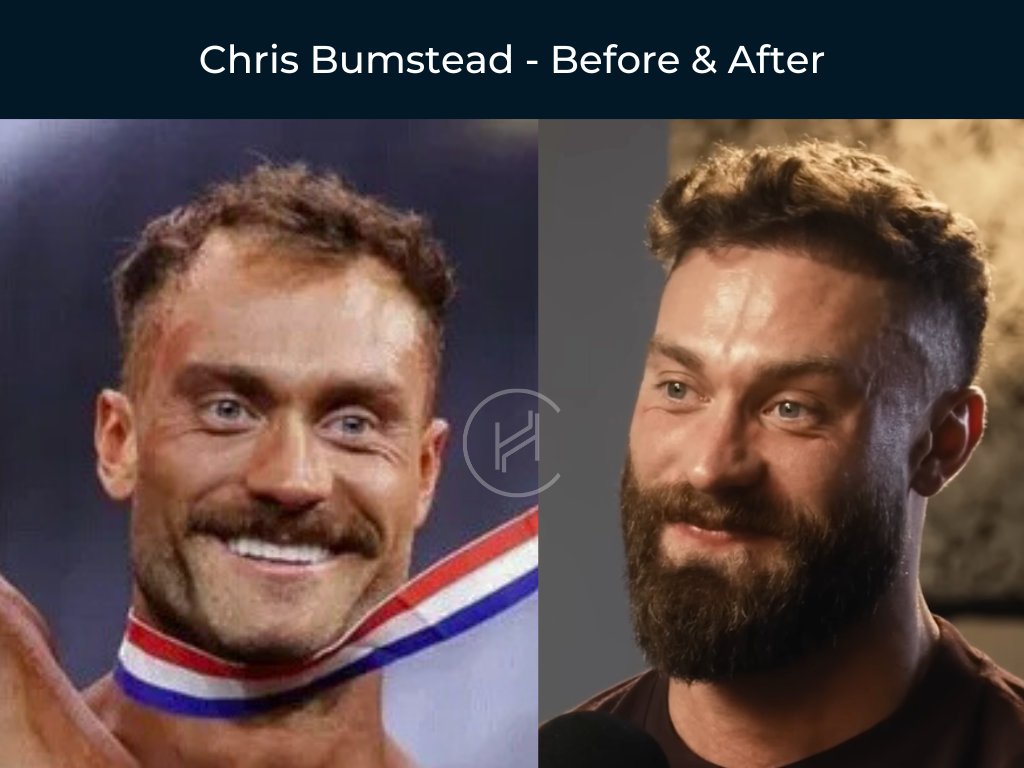 Chris Bumstead - Hair Transplant Before and After Chris Bumstead - Hair Transplant Before and After