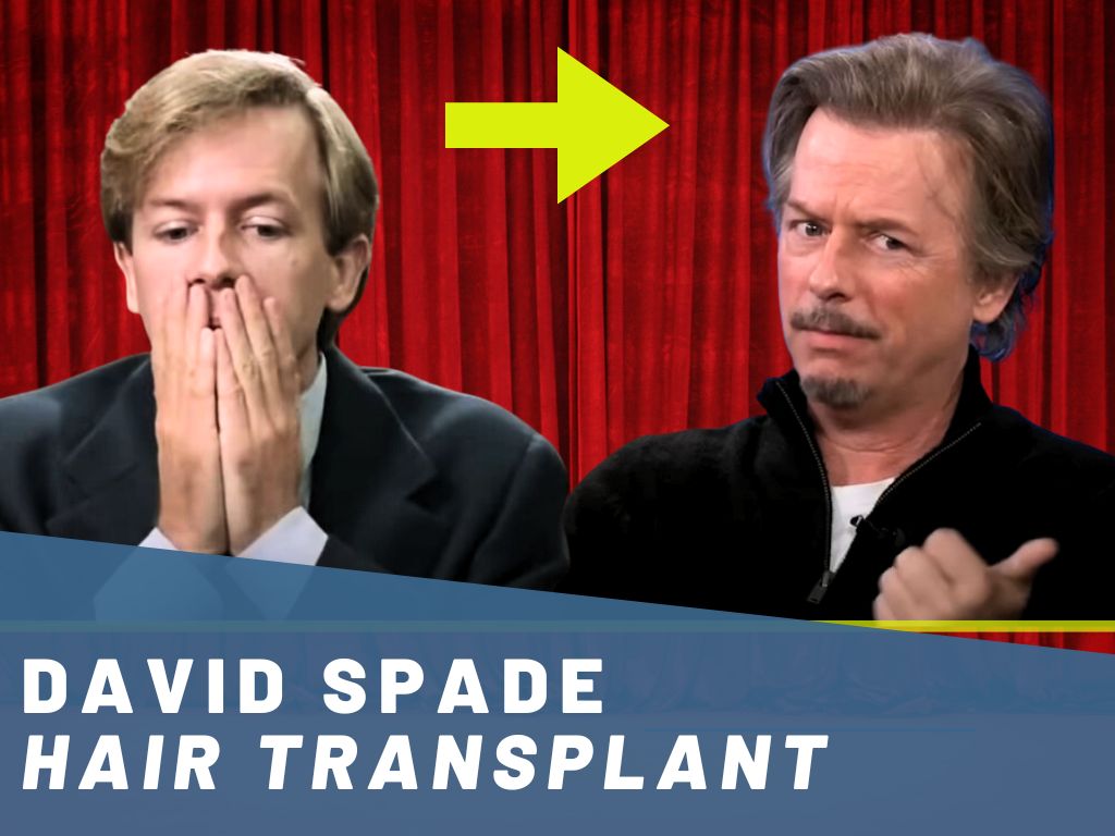 David Spade Hair Transplant Analysis Banner
